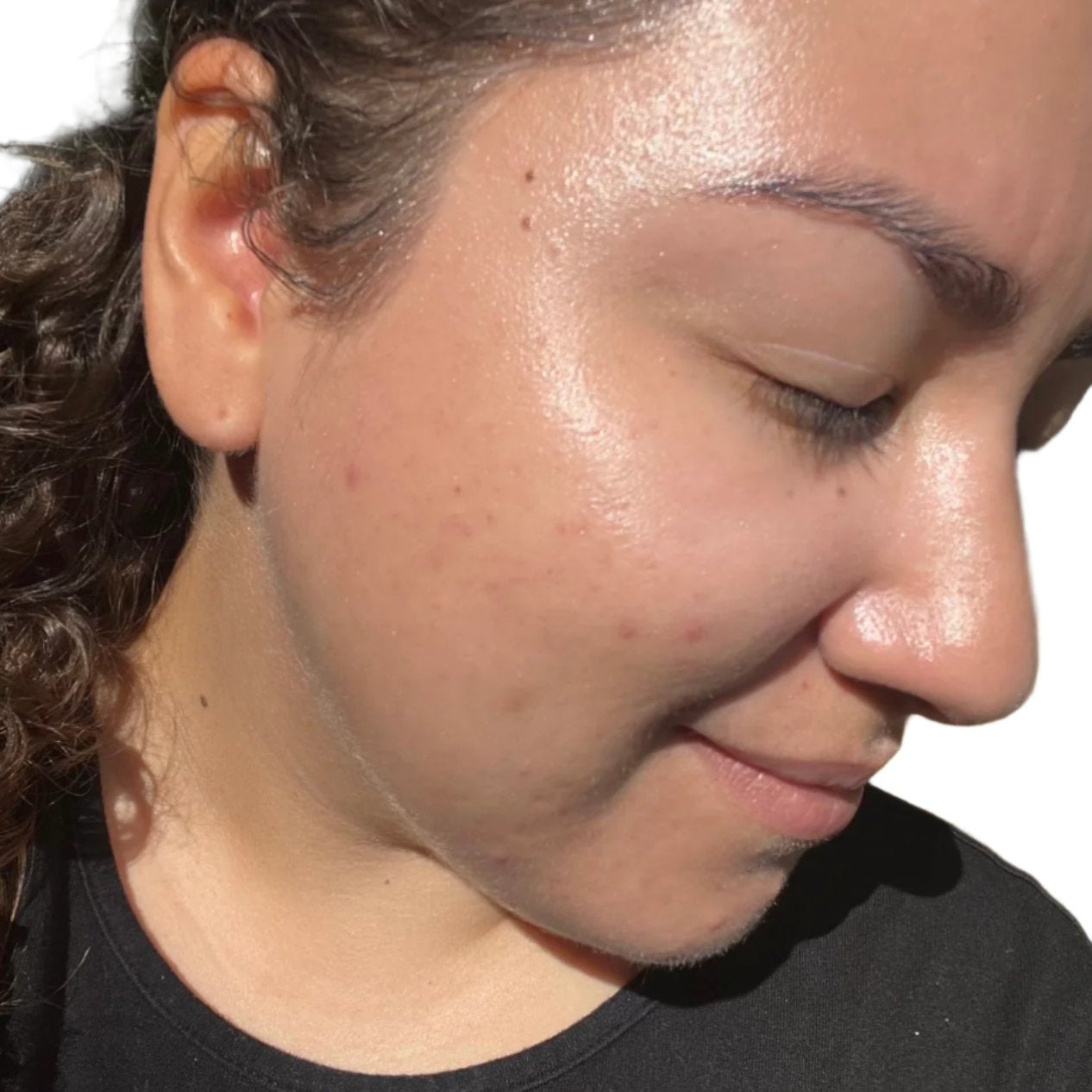 After using Acne Defense Kit with 4-step skincare products for acne-prone skin