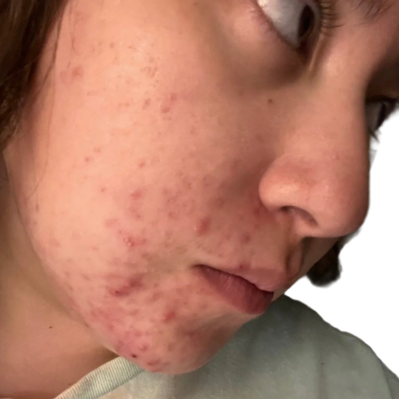 Before using Acne Defense Kit with 4-step skincare products for acne-prone skin