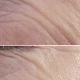 Two before and after eye area images of white skin wrinkles using best skin plumping serum. Dermal Essentials Medical Grade Skincare.
