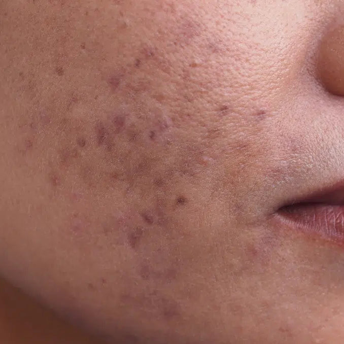 Before using brightening facial toner to reduced dark spots