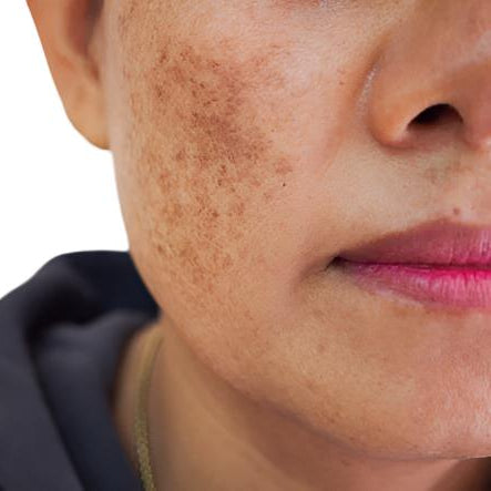 olive skin woman pink lipstick hyperpigmentation on cheeks fade facial cream dermal essentials medical grade skincare