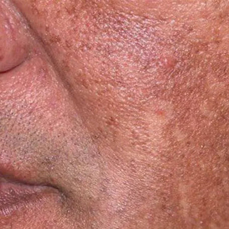 white man left cheek with hyperpigmentation. best hyperpigmentation-skincare-kit. dermal essentials medical grade skincare