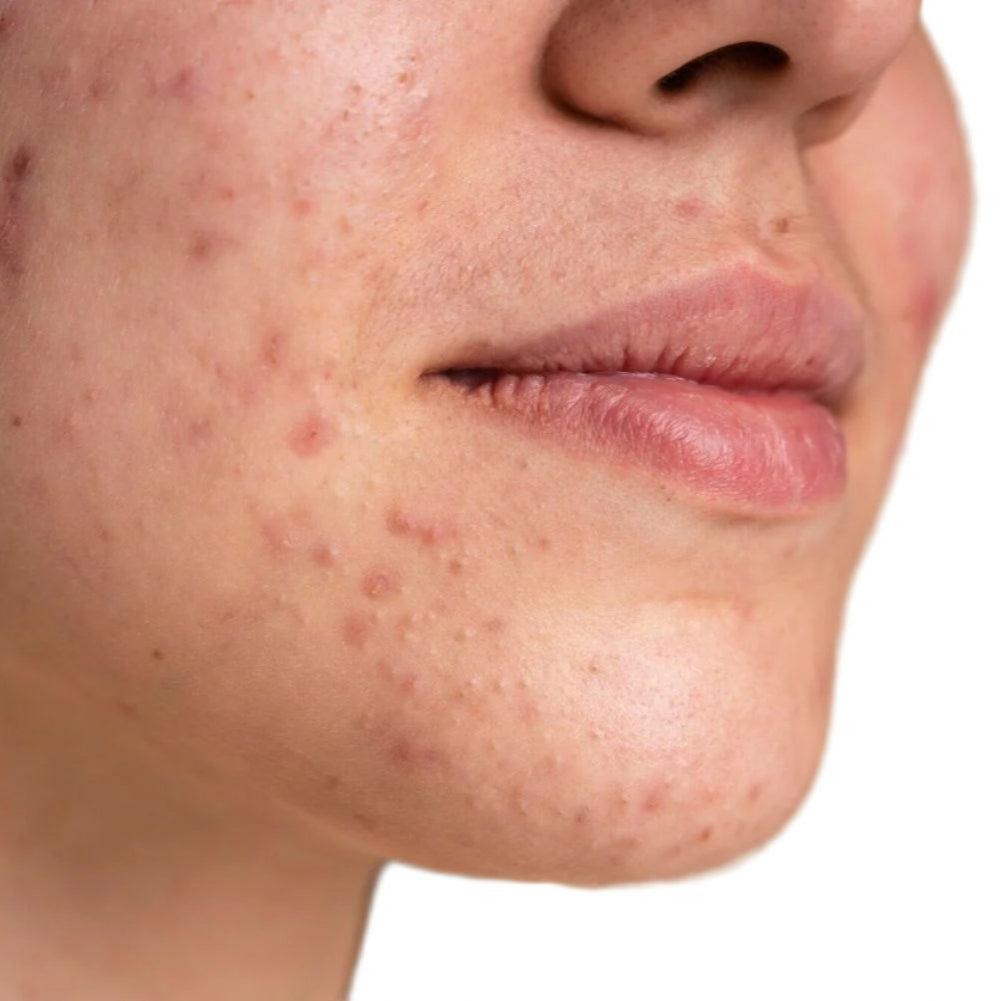 White woman face with acne.
Best pumice cleanser for face and body. Best acne cleanser. Dermal essentials medical grade skincare.