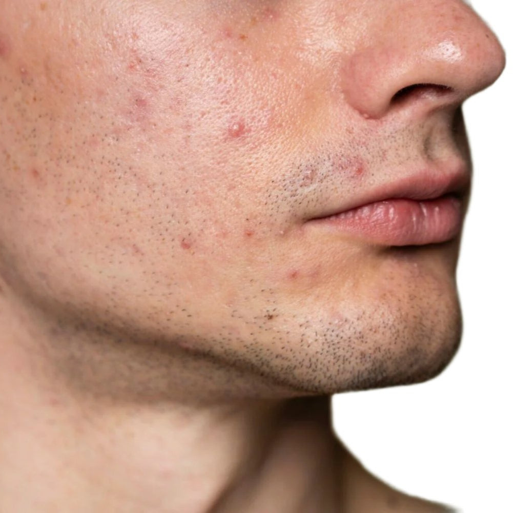 White male face with acne. Best pumice cleanser for face and body. Best acne cleanser. Dermal essentials medical grade skincare.