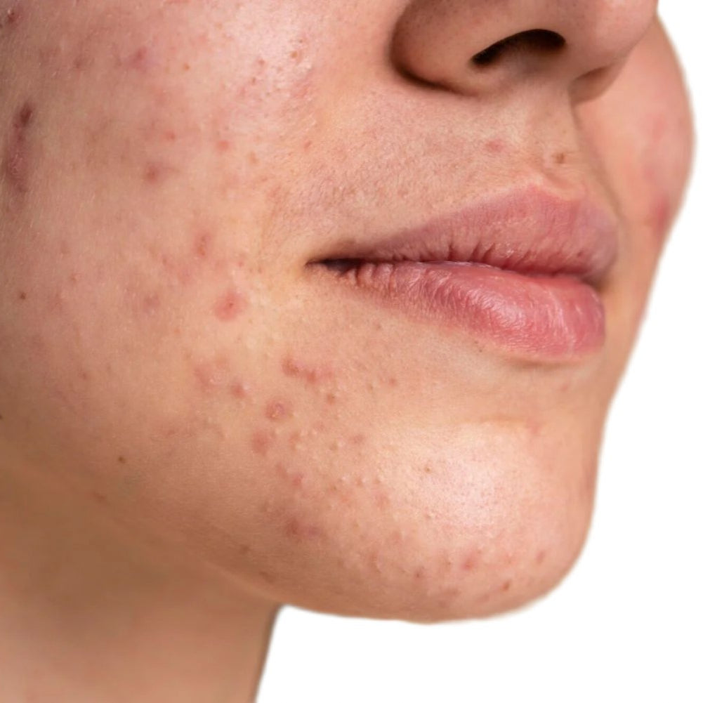 White woman face with acne.
Best pumice cleanser for face and body. Best acne cleanser. Dermal essentials medical grade skincare.