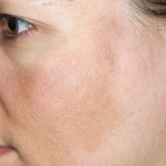 White woman profile with hyperpigmentation. Best vitamin c cream for face with hyperpigmentation. Dermal essentials medical grade skincare.