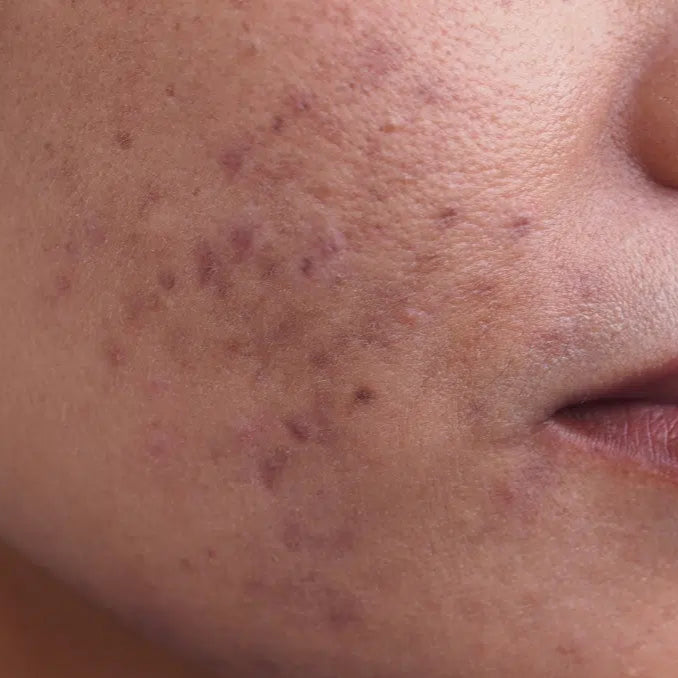 white woman forehead with hyperpigmentation dermal essentials medical grade skincare