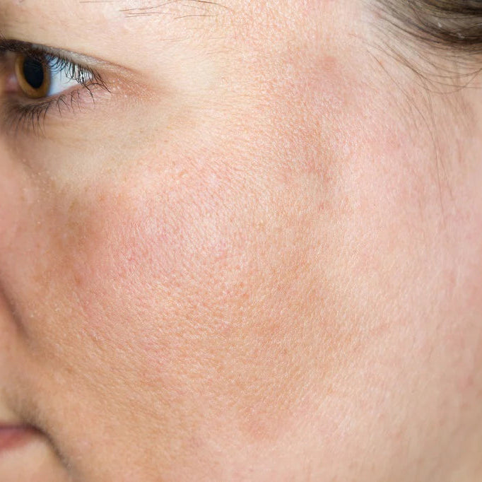 white woman profile with hyperpigmentation radian vitamin c cream dermal essentials medical grade skincare