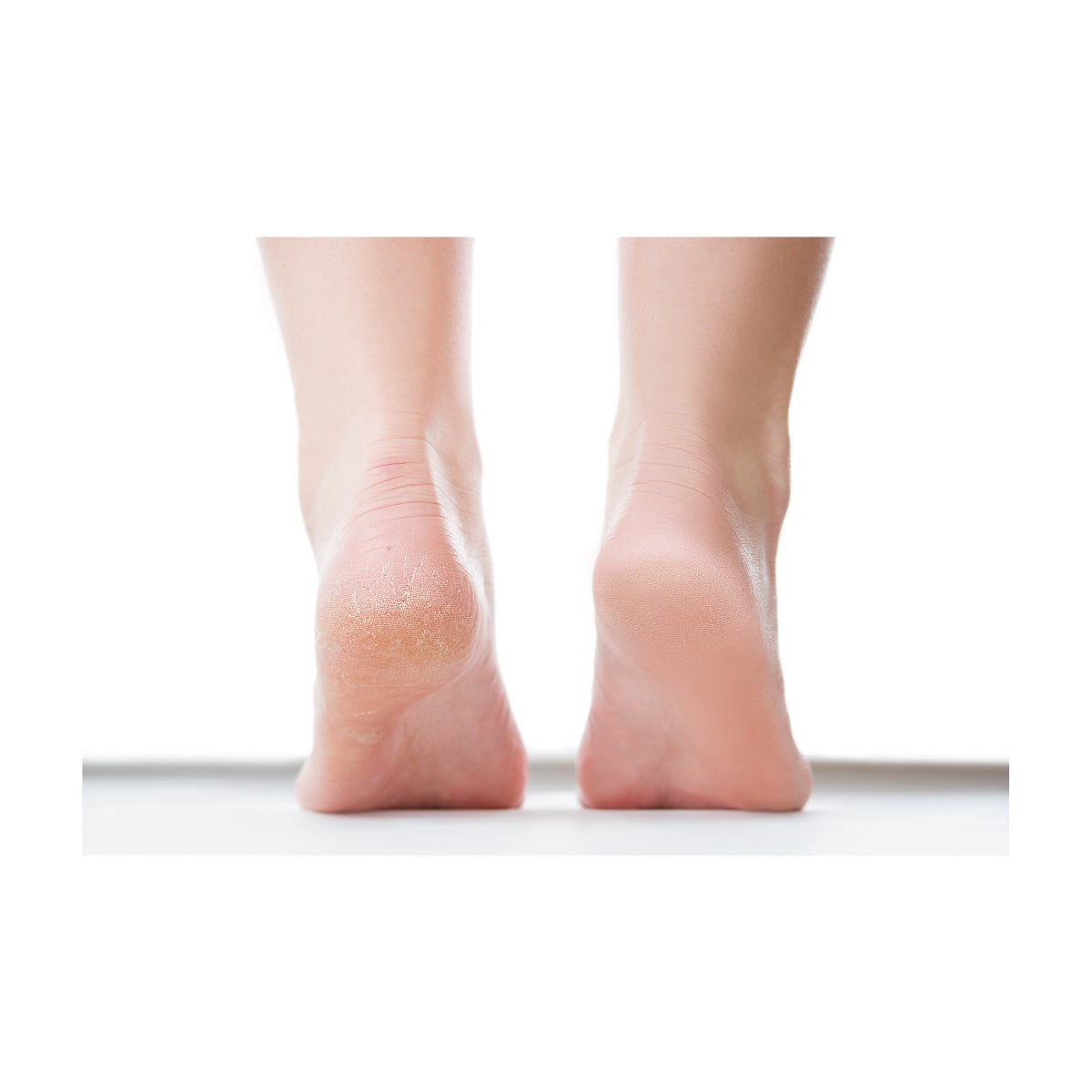 One cracked foot heel one smooth foot heel before and after Baby Foot Foot peel Dermal Essentials Medical Grade Skincare