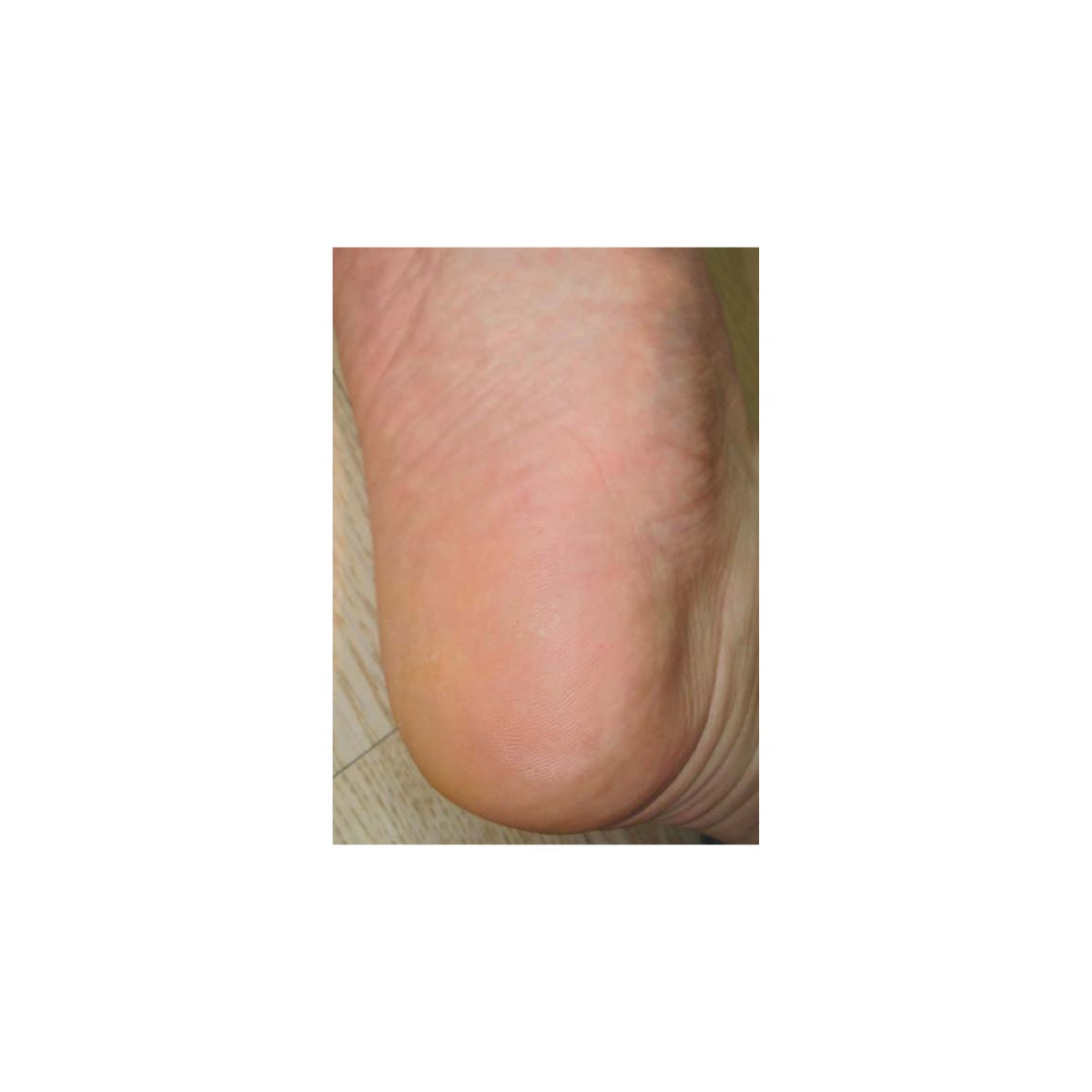 One smooth foot heel image. Baby Foot exfoliating original foot peel Dermal Essentials Medical Grade Skincare