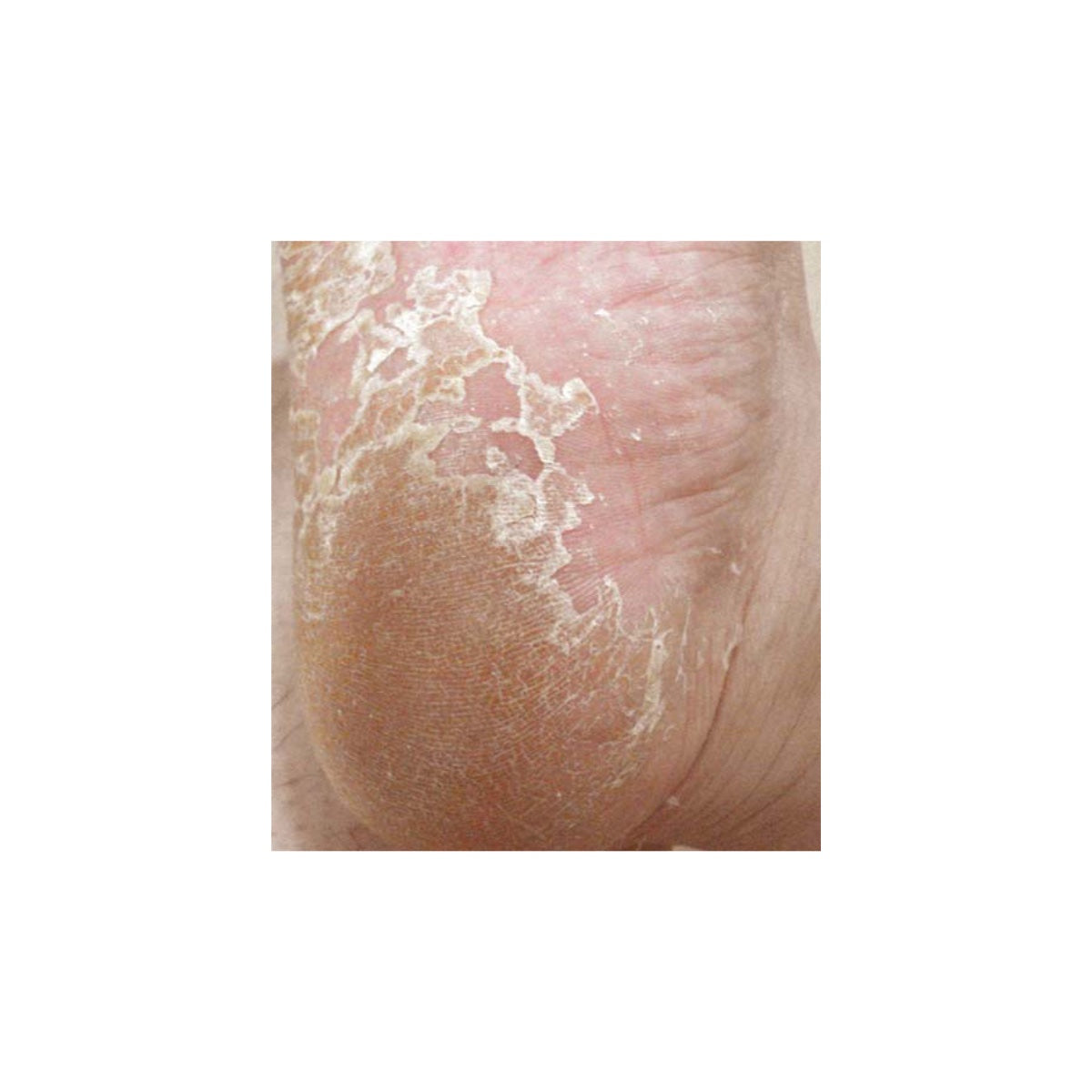 baby foot original: a foot peel