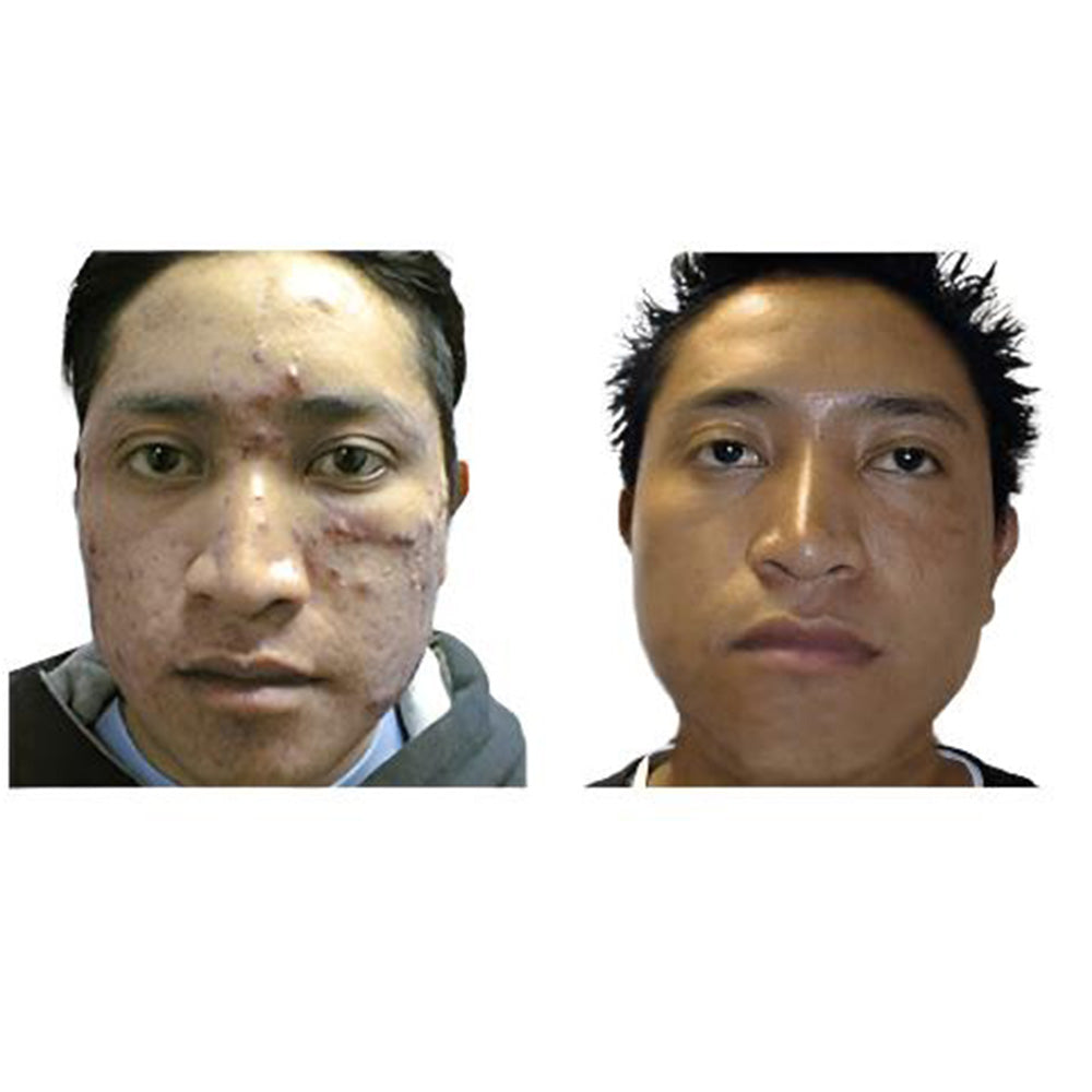 before and after Acne Defense Kit with 4-step skincare products for acne-prone skin.