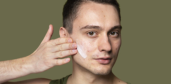 adult acne: why breakouts don’t stop after your teens