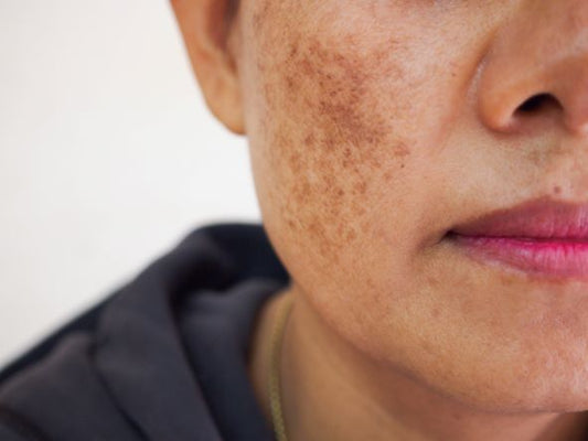 how to prevent & treat hyperpigmentation