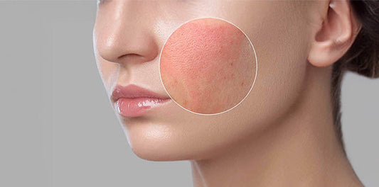 how to calm redness and care for sensitive skin