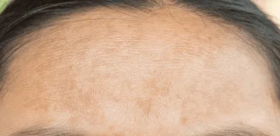 white woman forehead with hyperpigmentation Before the brightening effects of the toner