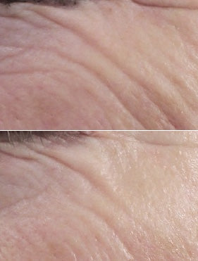 Two before and after eye area images of white skin wrinkles using best skin plumping serum. Dermal Essentials Medical Grade Skincare.