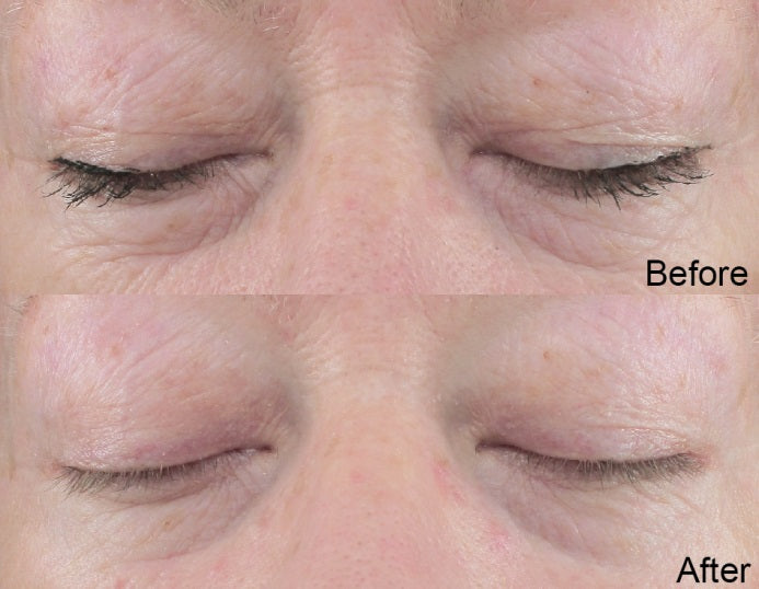 Two Before and after images of white skin eye area using best skin plumping serum. Dermal Essentials Clinical Skincare.