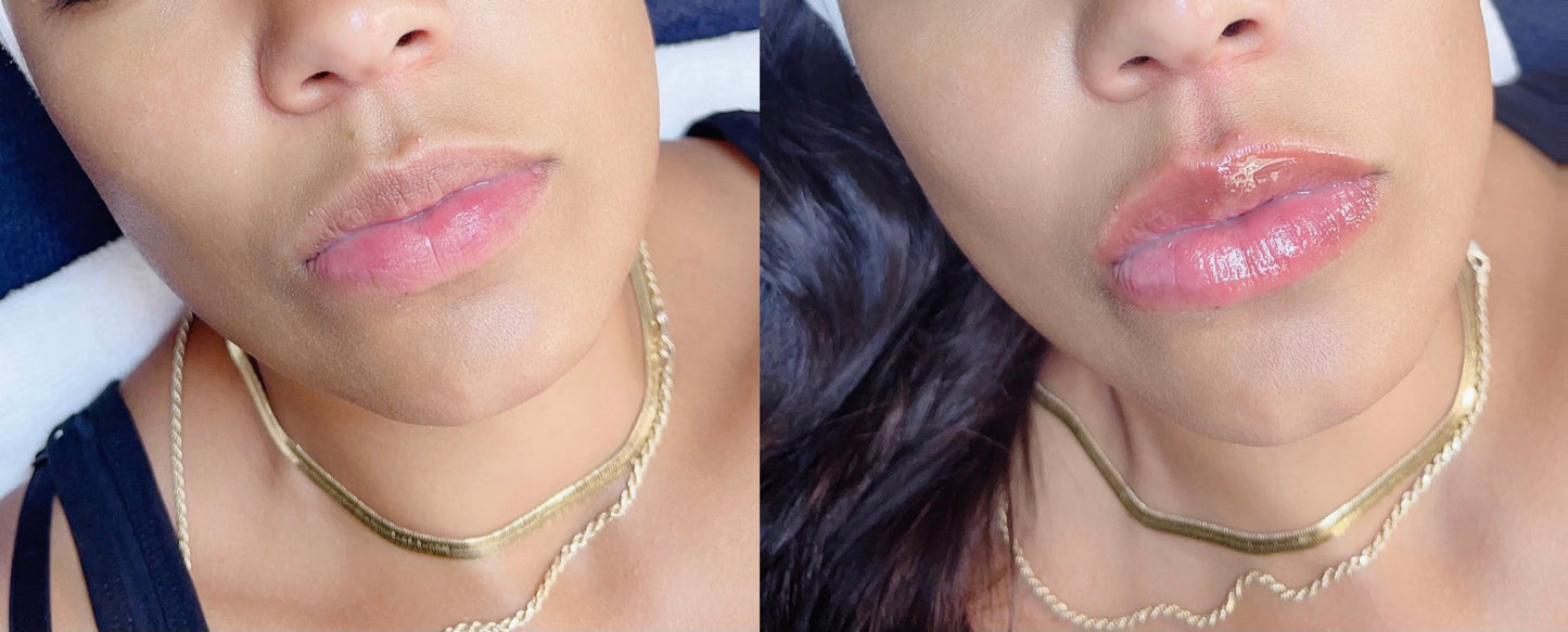 Before and after Pout lip plumper Dermal Essentials Medical Grade Skincare