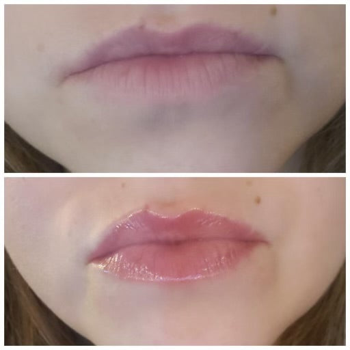 Lip before and after Pout lip plumper Dermal Essentials Medical Grade Skincare