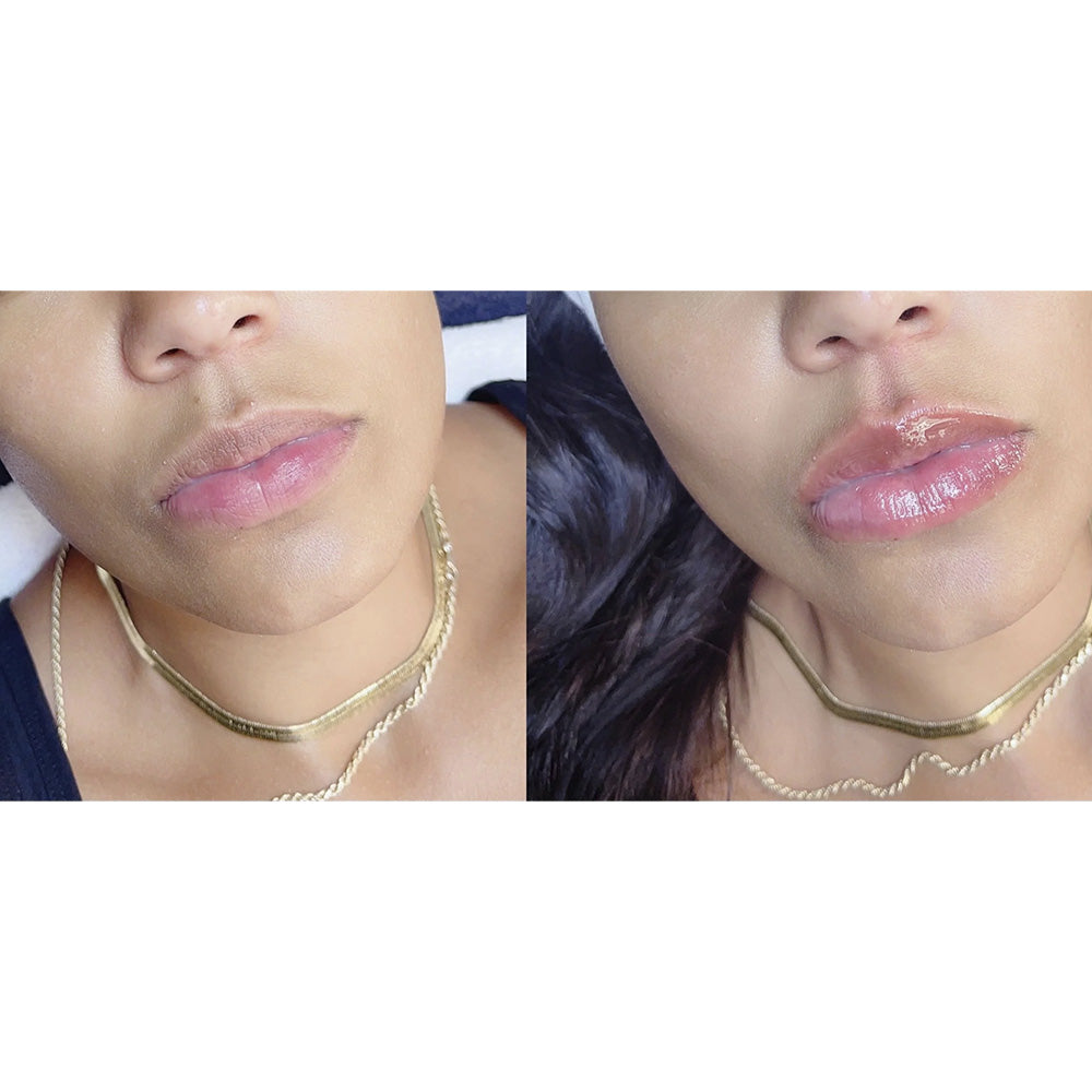 Before and after Pout lip plumper Dermal Essentials Medical Grade Skincare